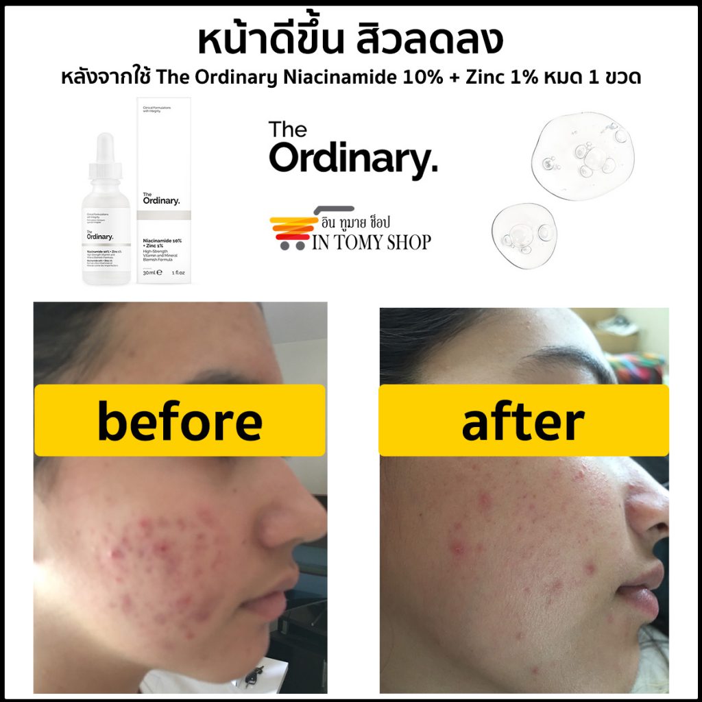 รีวิว The Ordinary Niacinamide 10% + Zinc 1%